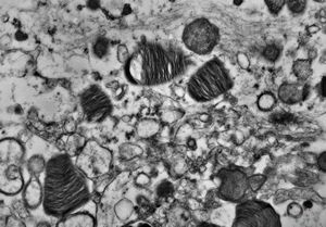 M, 6m. | Niemann-Pick disease - brain M, 6m. | Niemann-Pick disease - brain